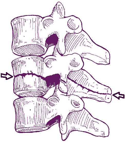 Channce Fracture (seat belf fracture)