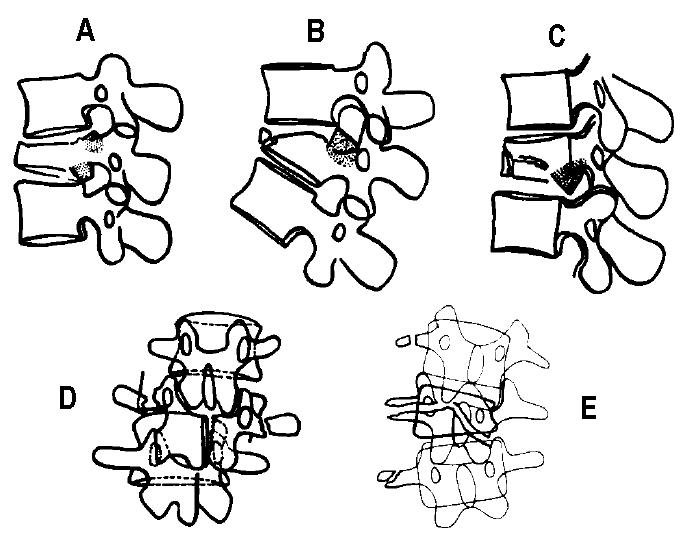 Denis' burst fracture subtypes