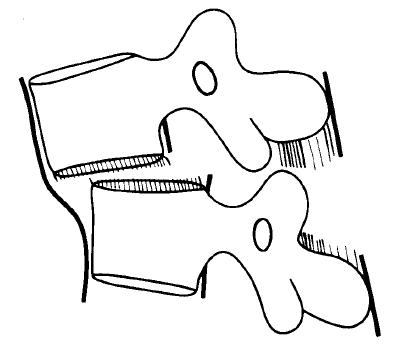 Denis' flexion distraction subtype