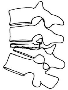 Denis' flexion-rotation subtype