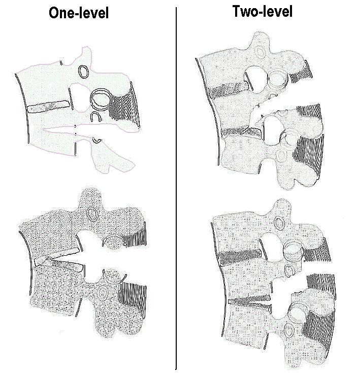Denis' seat-belt-type fractures sybtypes