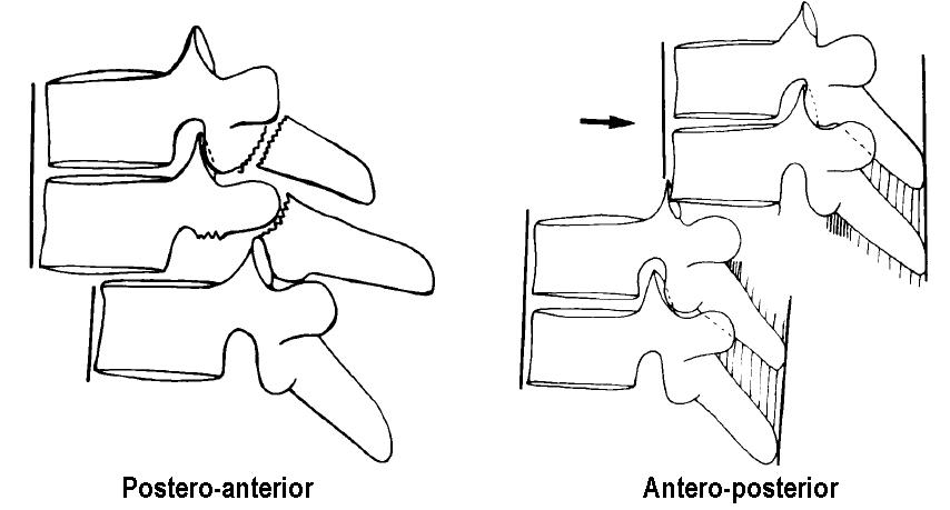 Denis' shear fracture subtypes