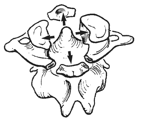 Jefferson Fracture
