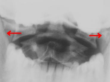 Open Mouth X-Ray of Jefferson Fracture