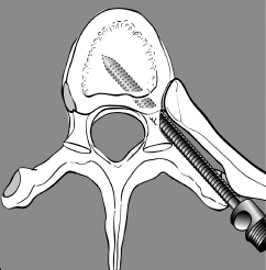 Extrapedicular Screw